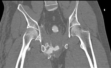 Pelvic Ct Scan