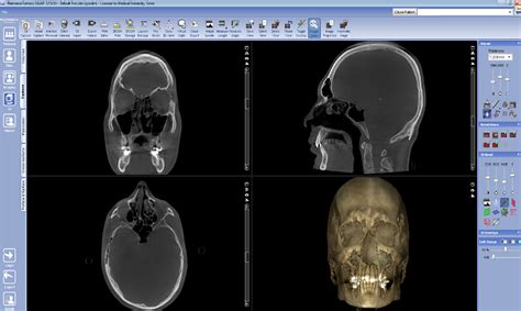 CBCT (3D скенер) на цял череп | Университетски медико-дентален център