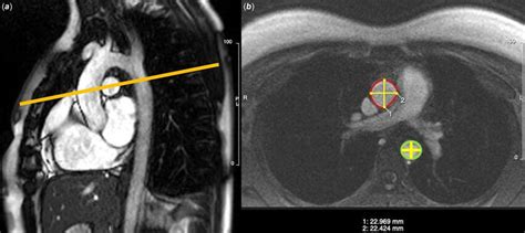 Aortic Measurements Showing A Sagittal Oblique View Of The Aorta And