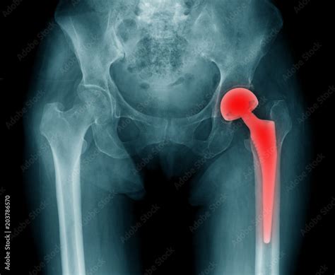 hip replacement x-ray, image of radiology hip arthroplasty Stock Photo ...