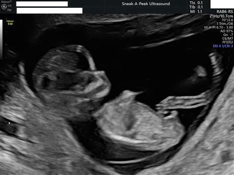 Early Pregnancy Scans | Sneak-A-Peek Ultrasound