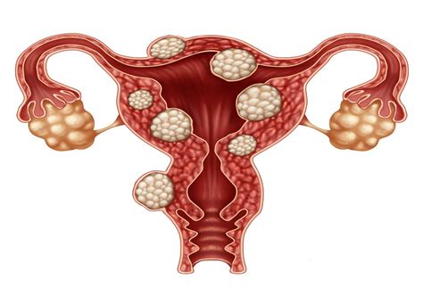 Miomas Qué son y cómo afectan a la reproducción femenina