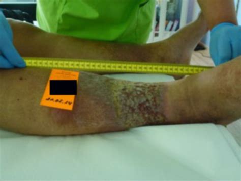 One Year Open Wound Ulcus Cruris DocCheck