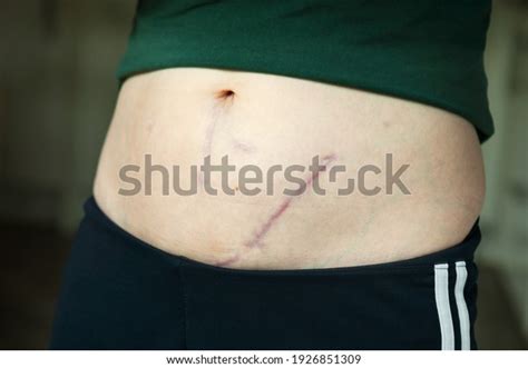 18 Kidney Transplant Scar Images, Stock Photos & Vectors | Shutterstock