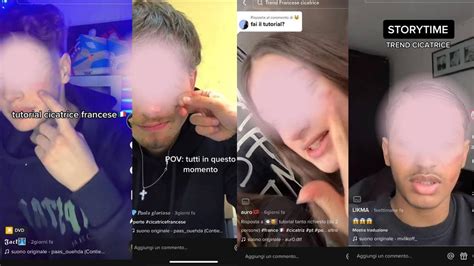 Cicatrice Francese Su Tik Tok Il Trend Del Tagliarsi Cosè E Perché è