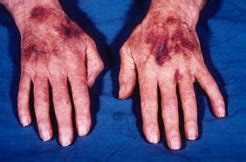 Senile purpura — Medlibes: Online Medical Library