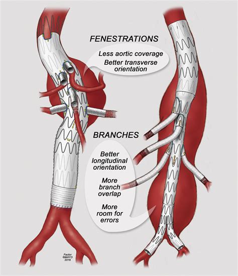 Endovascular Repair Of Thoracoabdominal Aortic Aneurysms Using