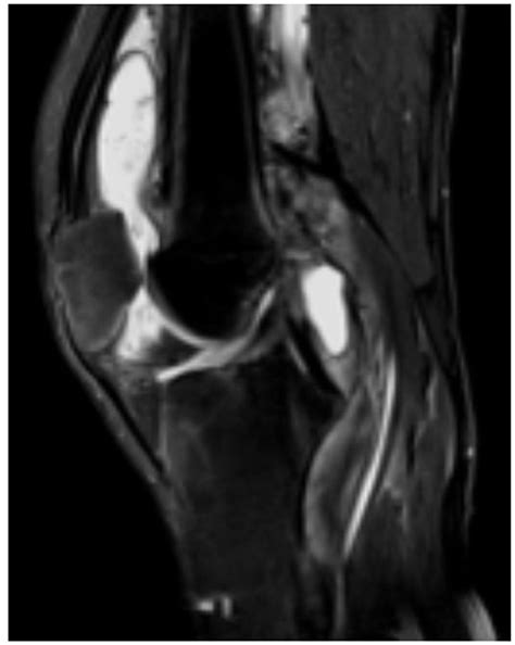 Pigmented Villonodular Synovitis Pvns 5