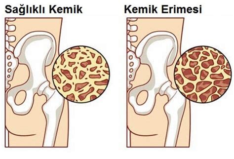 Kemik Erimesi Osteoporoz Nedir Belirtileri Finanspara