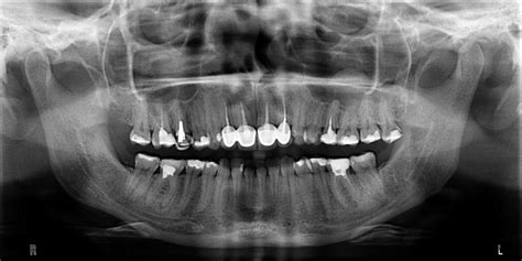 Nowoczesna Diagnostyka Stomatologiczna RTG Tomograf Komputerowy