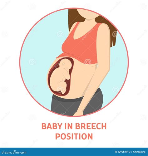 Medical Reasons for Cesarean Delivery or C-section Stock Vector ...