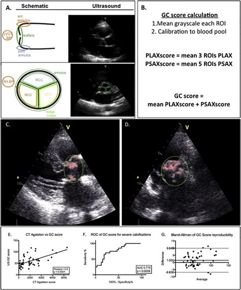 Clinical Validation Of An Ultrasound Quantification Score For Aortic