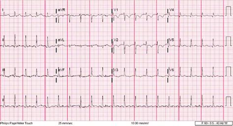 Borderline Ecg Lecture X Ekg Test Q Waves Flashcards Quizlet