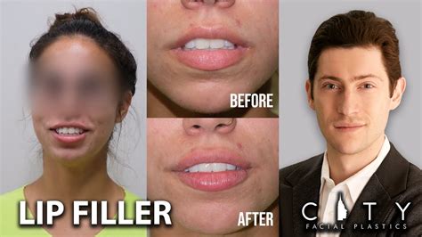 New York Lip Filler Patient Testimonial Dr Gary Linkov YouTube