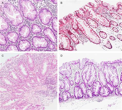 Molecular Features Of Colorectal Hyperplastic Polyps And Ses The