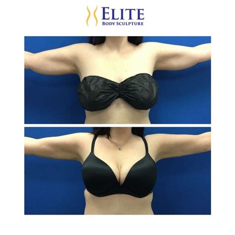 Pin On Airsculpt® Before And After Elite Body Sculpture