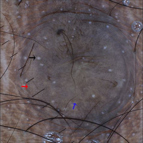 Dermoscopic Features Of Epidermoid Cyst Beyond Punctum Indian Journal Of Dermatology