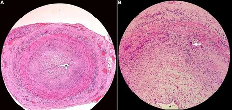 Figure Superficial Temporal Artery Histopathology This Image