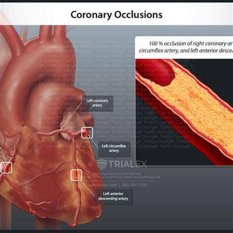 Coronary Occlusions Trialexhibits Inc