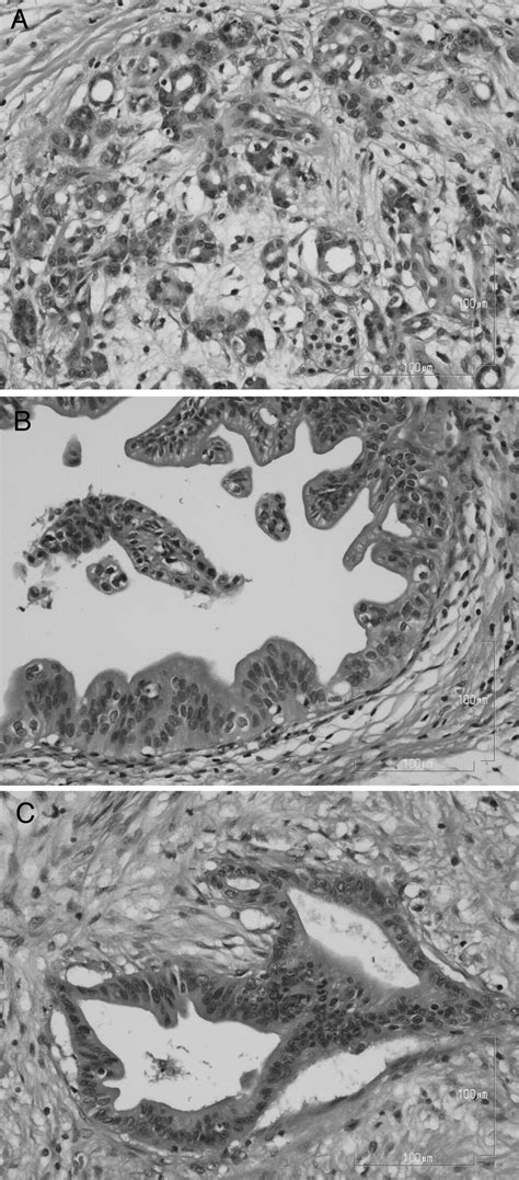 Molecular Pathology Of Pancreatic Cancer Implications For Molecular