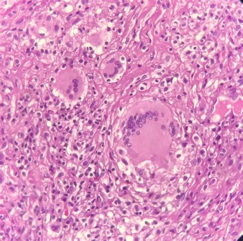 Radiopaedia case Paracoccidioidomycosis (histology) id: 54067 study ... 
