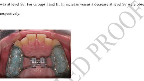 Rapid Maxillary Expansion Appliance Download Scientific Diagram