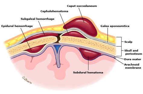 Caput Succedaneum Vs Cephalohematoma