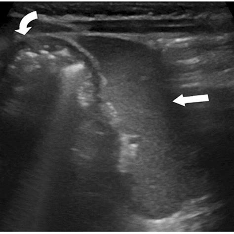 Wandering Spleen On Ultrasound Sagittal Grey Scale Ultrasound Image