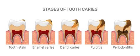 How to Prevent Tooth Decay in Toddlers | MGA Dental