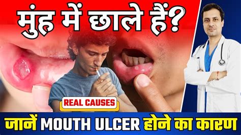 बार बार मुंह में छाले होते हैं जानें Mouth Ulcer होने का कारण What