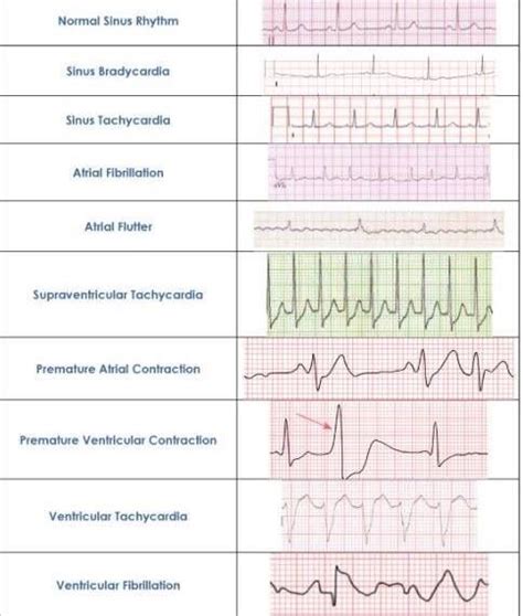 How To Interpret Ekg Rhythms