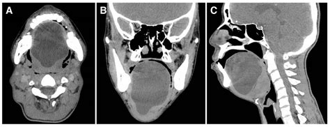 Dermoid Cyst Oral