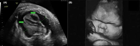 Successful Management Of Extremely Highoutput Refractory Congenital