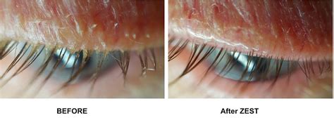 Dry Eye Treatment Dry Eye Syndrome Dry Eyes Optometrist