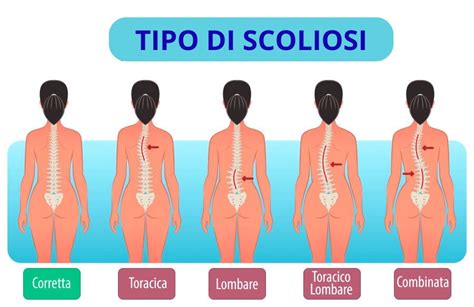 Cosa è La Scoliosi Cosa è La Scoliosi trattamento per la scoliosi