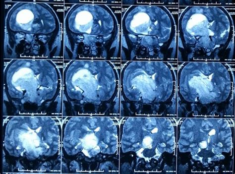 Giant Pituitary Adenoma Can It Grow Bigger Than This Bmj Case Reports