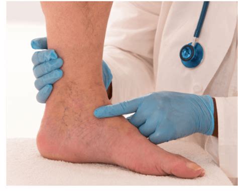 Peripheral Arterial Disease South Carolina Podiatrist Coastal