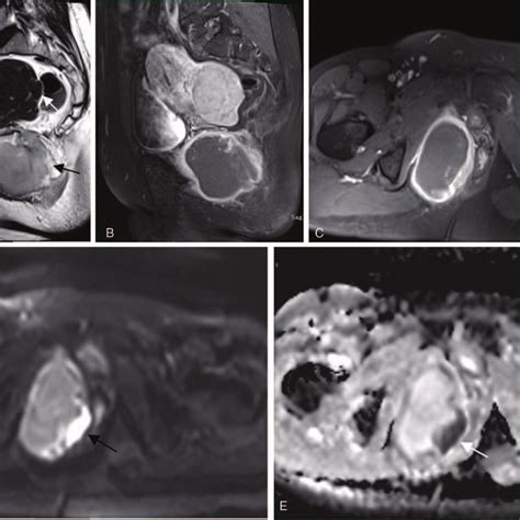 Mr Examination Of The Pelvis A Sagittal T2 Weighted Image Showed A