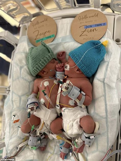 Siamese Twin Brothers Celebrate Their First Birthday Together A Year