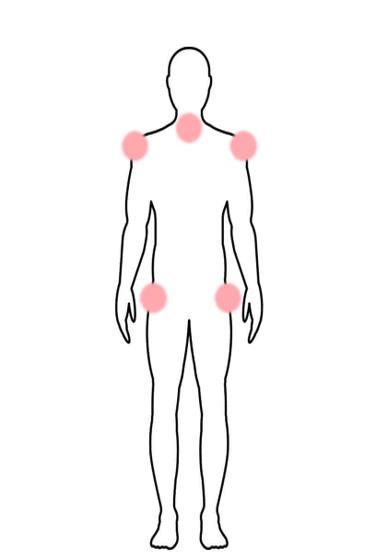 Polymyalgia Rheumatica Understanding The Signs And Symptoms