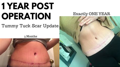 Tummy Tuck Scar 1 Year Post Op Did I Make A Mistake Youtube