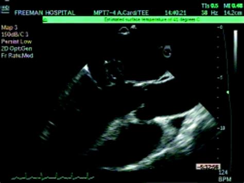 Perforated Mitral Valve Leaflet Heart