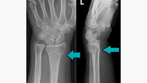 X Ray Of Human Hand With Broken Wrist Fracture Of Radius