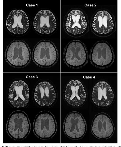 Figure From Pathologic Correlation Of Paramagnetic White Matter