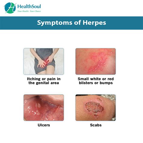 Herpes Simplex Hsv Types Causes Symptoms And Treatmen Flickr | Sexiz Pix