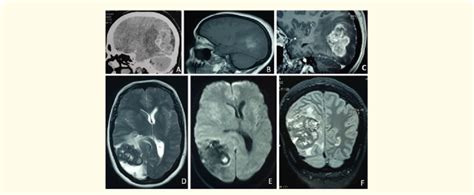 Right Occipital Brain Tumor A Ct Scan B To E Mri With Heterogeneous