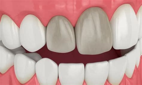 How To Treat Teeth Discoloration In Oshawa