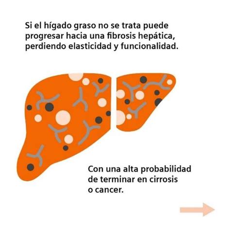 Esteatosis hepática no alcohólica Siemens Healthineers Argentina