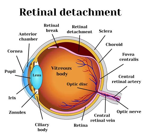 Retinal Detachment Risks | Retina Associates Kansas City