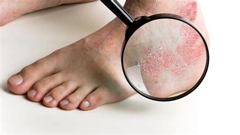 Psoriasis - Why is it such a Nuisance to Deal With? - Podiatry HQ